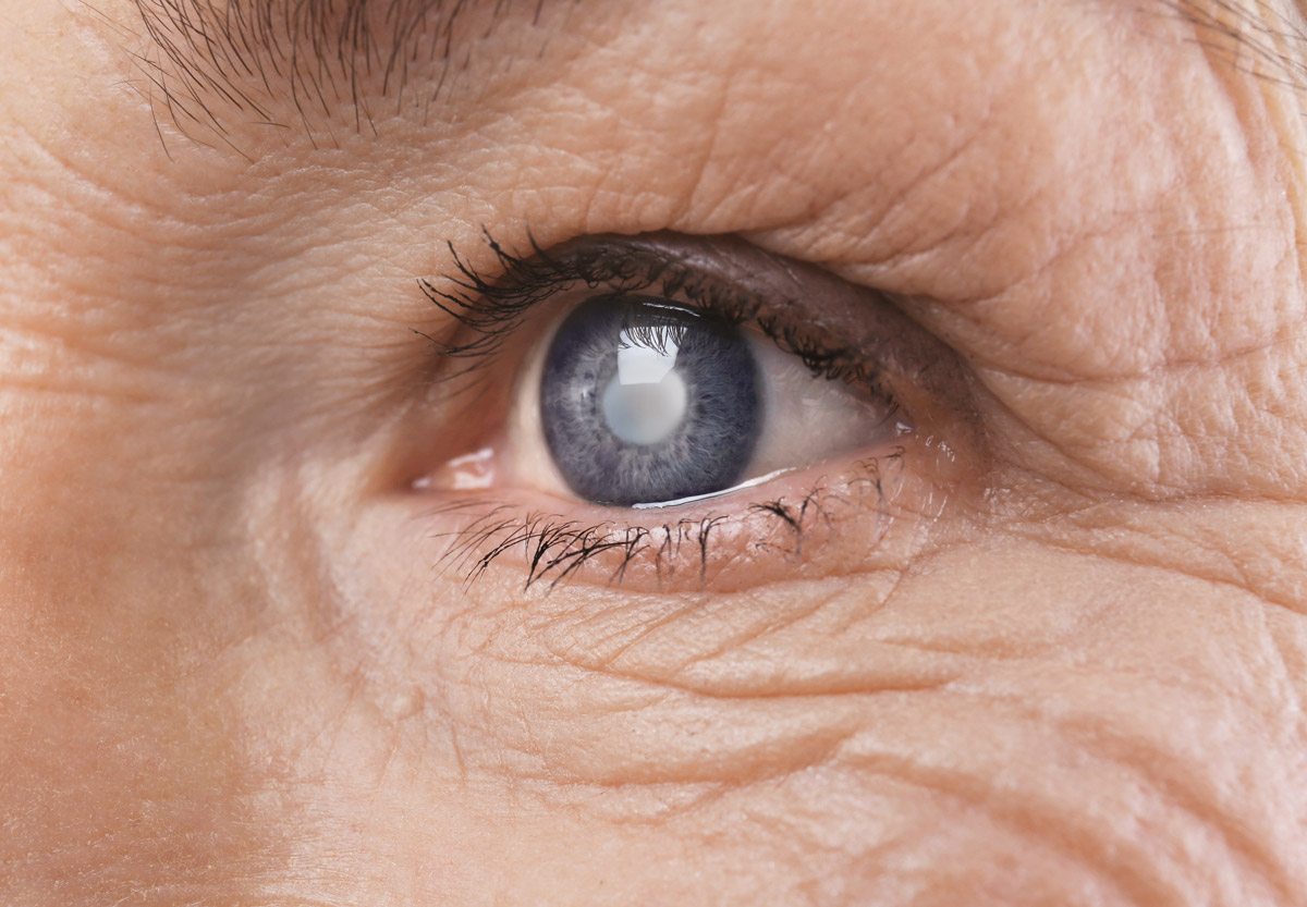 Image illustrant la cataracte